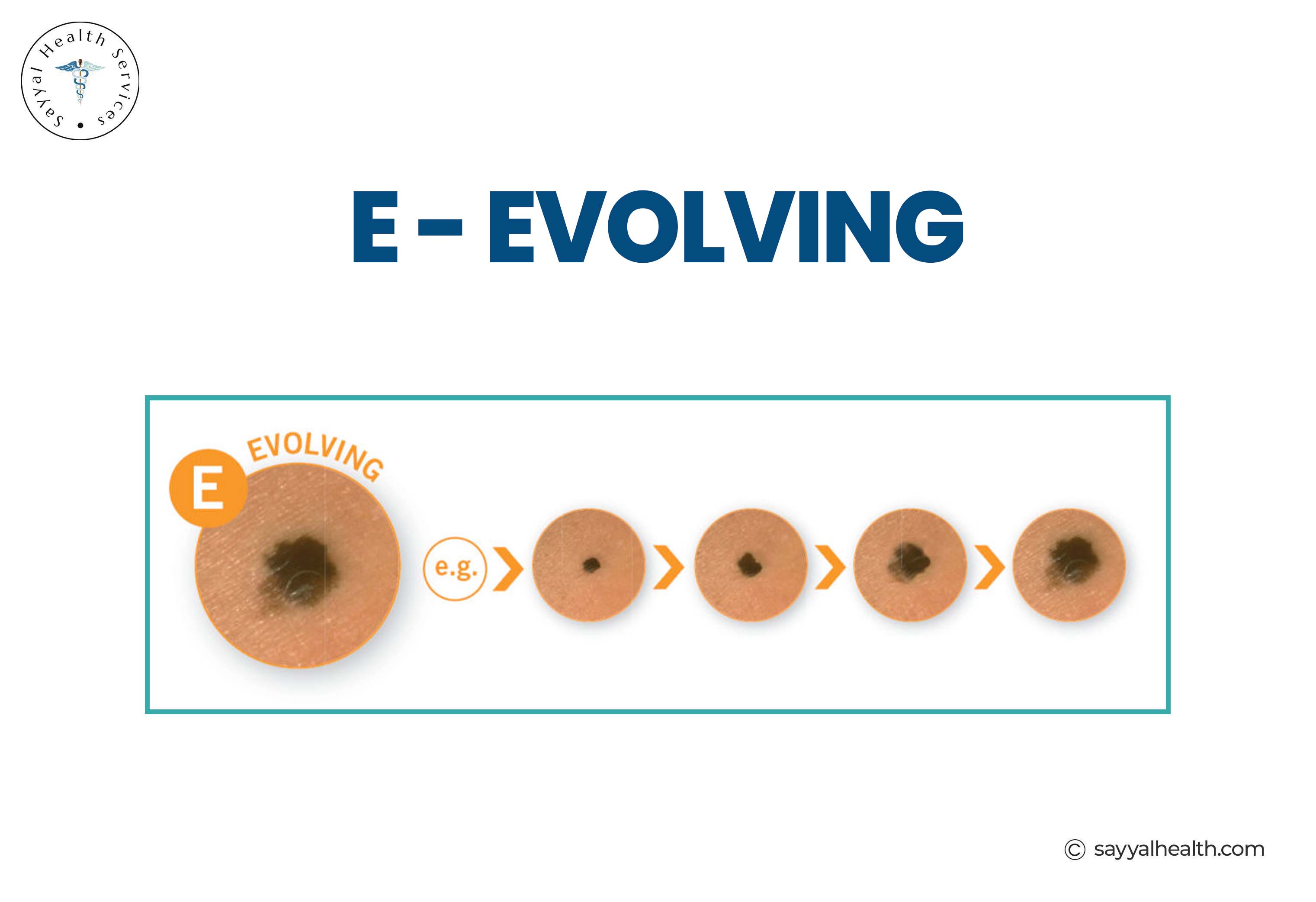E - Evolving melanoma showing progression and changes in mole appearance over time